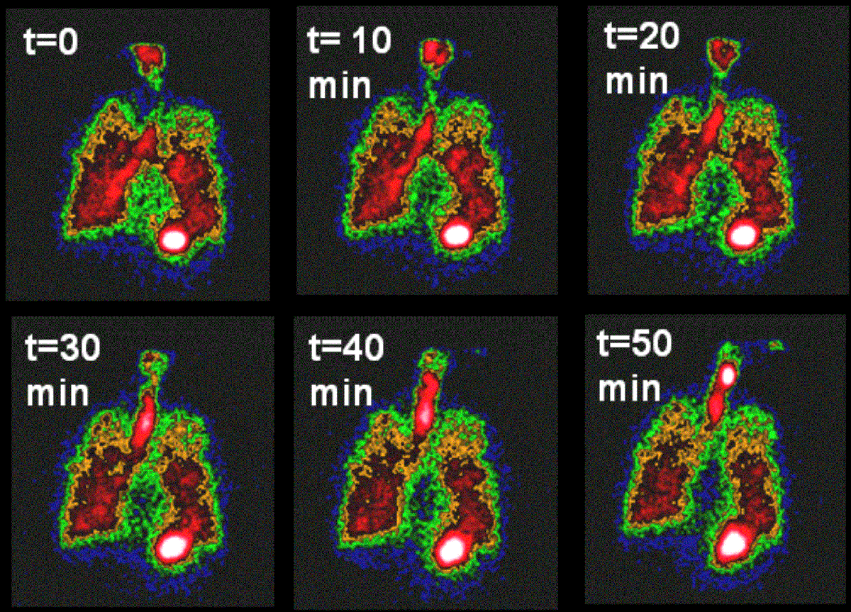 Nuclear imaging shows mucus clearance from the lungs. These imaging techniques can be used along with systems models to develop treatments for cystic fibrosis.